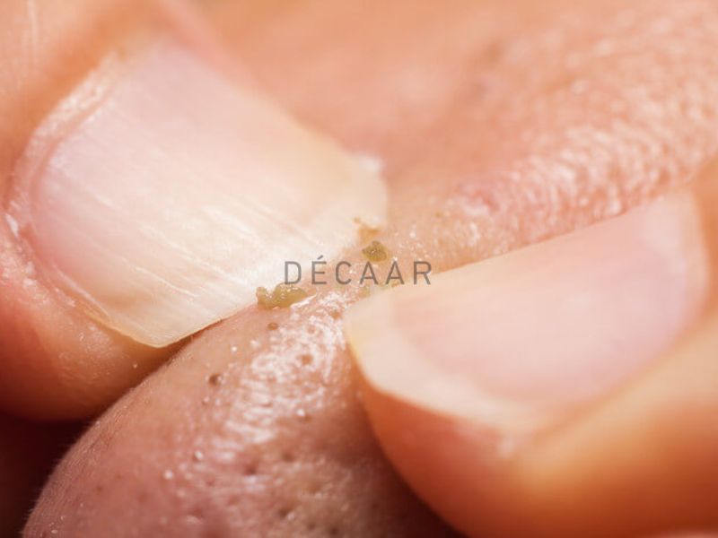 có nên nặn mụn đầu đen ở mũi không